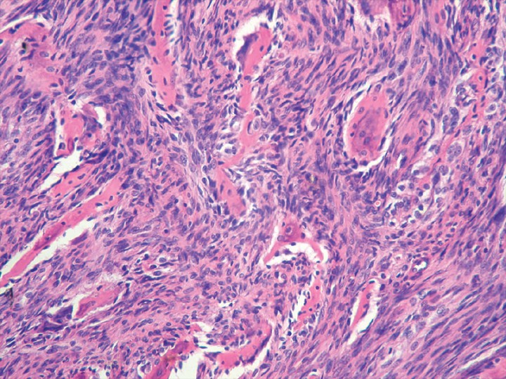 <p>Imagen microscópica del tejido extirpado. Se observan áreas de proliferación neoplásica mesenquimatosa formadas por elementos de rasgos fusiformes y pleomórficos con bajo índice mitótico (Hematoxilina & Eosina x 200). Diagnóstico: osteosarcoma osteoblástico de bajo grado (imagen cedida por Histovet).</p>