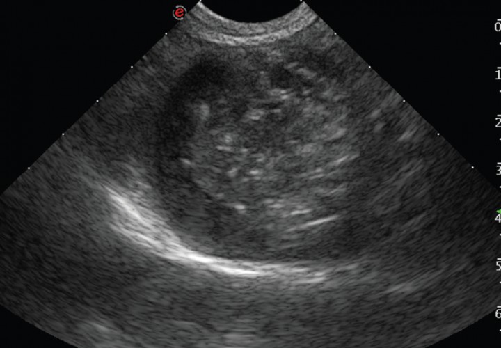 <p>Imagen ecográfica de la vesícula biliar en corte transversal. Modelo de mucocele biliar de Tipo I: se observa la vesícula biliar distendida con gran cantidad de contenido ecogénico inmóvil en su interior.</p>