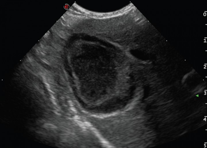 <p>Imagen ecográfica de la vesícular biliar en corte longitudinal. Modelo de mucocele biliar de Tipo II: se visualiza contenido en la vesícula biliar ecogénico inmóvil adherido a la pared y una moderada cantidad de sedimento móvil.</p>