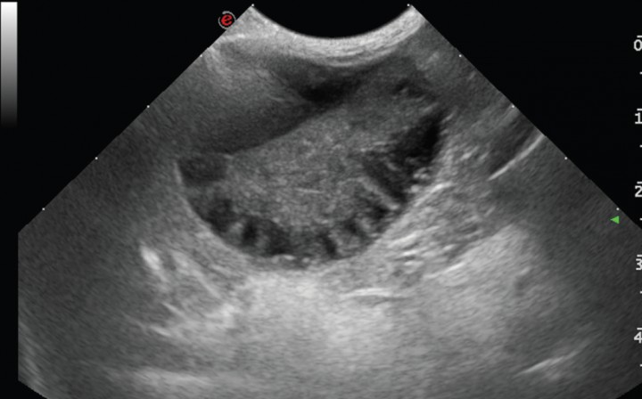 <p>Imagen ecográfica de la vesícula biliar en corte transversal. Modelo de mucocele biliar de Tipo III: la vesícula biliar se observa distendida con contenido ecogénico inmóvil en su interior adherido a la pared y material ecogénico en el centro que emite prolongaciones hipoecogénicas hacia la periferia presentando una forma de estrella.</p>