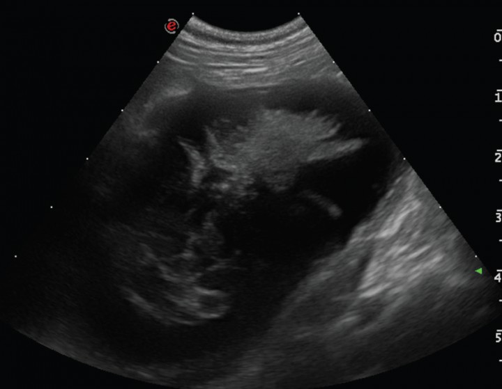 <p>Imagen ecográfica de la vesícula biliar en corte longitudinal. Modelo de mucocele biliar de Tipo IV: en el interior de la vesícula biliar se aprecian dos tipos de sedimentos inmóviles; uno ocupando la zona central con estriaciones hacia la periferia y otro de aspecto más amorfo sin estriaciones hacia la periferia.</p>