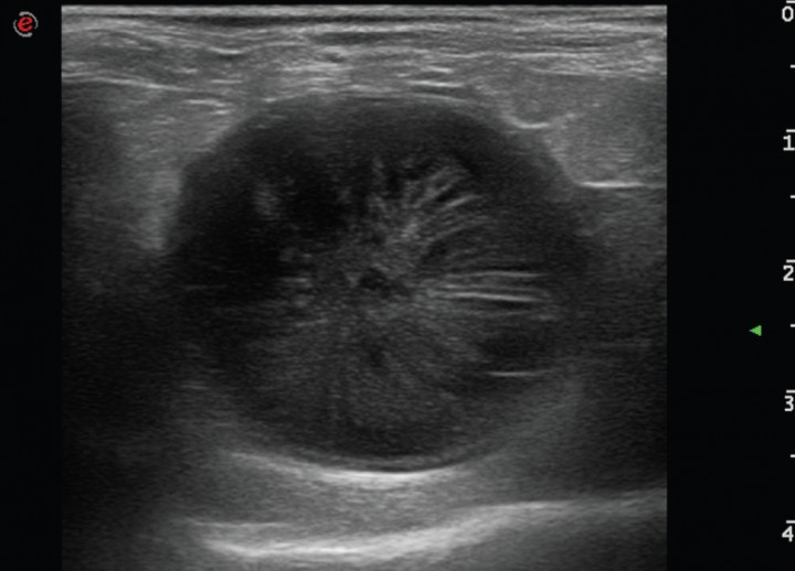 <p>Imagen ecográfica de la vesícula biliar en corte transversal. Modelo de mucocele biliar de Tipo V: el contenido de la vesícula biliar es ecogénico e inmóvil en forma de estriaciones hacia la periferia produciendo aspecto de kiwi.</p>