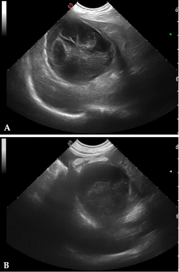 <p>Imagen ecográfica de la vesícula biliar en corte transversal de un Chihuahua hembra de 5 años que presentaba vómitos, letargia y dolor abdominal. (A) Se visualiza la vesícula biliar aumentada de tamaño, con la pared irregular y engrosada, con contenido ecogénico inmóvil (mucocele biliar de Tipo IV). (B) Además se observaba el peritoneo adyacente hiperecogénico y presencia de líquido libre, siendo el diagnóstico definitivo rotura de la pared de la vesícula biliar y peritonitis focal.</p>