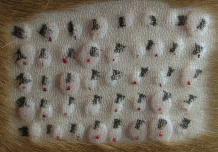 <p>Test intradérmico antes de proceder a la lectura. Las dos últimas reacciones de la esquina inferior derecha corresponden a los controles positivo y negativo, respectivamente.</p>