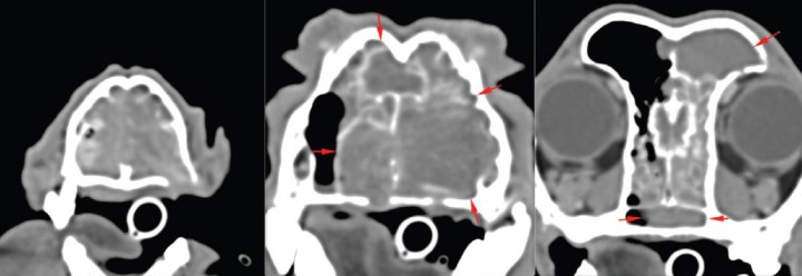 <p>Imagen en TC post-contraste en plano transversal y ventana de tejido blando. Se aprecia una masa que ocupa la cavidad nasal izquierda e invade parte de la derecha, con lisis de los huesos palatino, lacrimal izquierdo, maxilar y senos frontales, sin invasión de la lámina cribosa.</p>