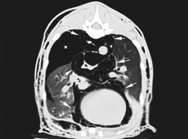 <p>Corte transversal de TC en ventana de pulmón. Se observa neumomediastino (flechas blancas) y neumotórax (asterisco blanco).</p>