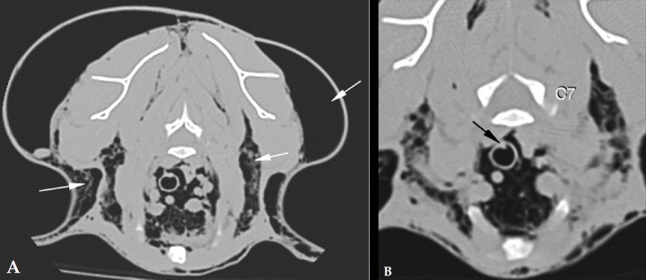 <p>(A) Corte transversal en ventana hueso a nivel de C7. Las fechas blancas señalan enfisema subcutáneo entre fascias. (B) Ampliación de la zona de la traquea. Se observa un defecto a nivel de la pared dorsal de la tráquea (flecha negra).</p>
