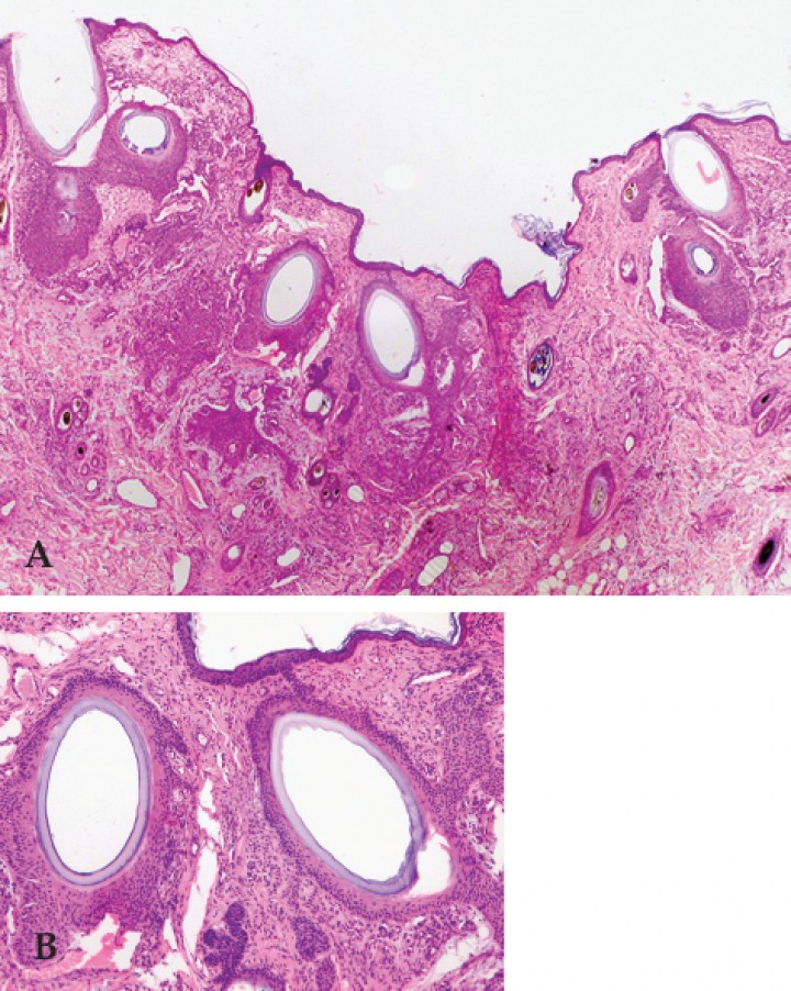 <p>(A) Imagen histopatológica del caso 1 donde se puede ver la reacción epidérmica característica y la formación de la cutícula larval cubriendo el folículo (Hematoxilina-Eosina, 100X). (B) Histopatología a más aumentos (400x). Obsérvense las cutículas (Imagen cortesía de Histovet).</p>