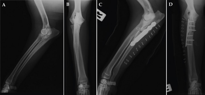 <div class=\"Basic-Text-Frame\">
<p>Radiografía lateral (A) y cráneo-caudal (B) prequirúrgicas de un codo afectado de enfermedad del compartimento medial. Radiografía lateral (C) y cráneo-caudal (D) postquirúrgicas inmediatas; se aprecia la osteotomía y la colocación de la placa correctamente, observándose el desplazamiento del fragmento proximal producido por el implante.</p>
</div>
