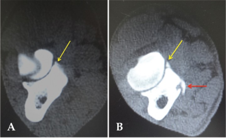 <div class=\"Basic-Text-Frame\">
<p>Imágenes de tomografía computarizada en plano transversal y ventana de huesos. (A) Se evidencia un fragmento de coronoides medial (flecha amarilla). (B) Imagen de otro paciente en el que además del fragmento craneal (flecha amarilla), se aprecia la deformidad del coronoides y la presencia de un osteofito en la zona medial del coronoides (flecha roja).</p>
</div>