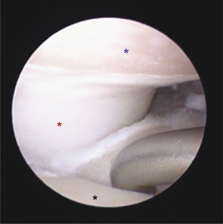 <div class=\"Basic-Text-Frame\">
<p>Imagen artroscópica de codo con síndrome de compartimento medial, donde se aprecia el cóndilo lateral humeral íntegro (asterisco rojo), la región cráneo-medial del coronoides medial con una erosión cartilaginosa de espesor completo (asterisco negro), al igual que en el cóndilo medial (asterisco azul). Nótese que con el palpador se está levantando el fragmento existente en el coronoides medial.</p>
</div>
