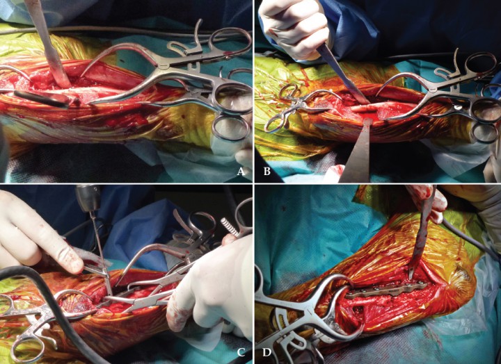 <div class=\"Basic-Text-Frame\">
<p>Imágenes intraquirúrgicas. (A) Se expone la diáfisis cubital proximal tras un abordaje caudolateral. (B) Corte de osteotomía realizado. (C) Reducción y colocación de los tornillos de la placa. (D) Imagen final de la placa colocada.</p>
</div>