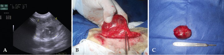 <div class=\"Basic-Text-Frame\">
<p>(A) Imagen ecográfica del lóbulo tiroideo izquierdo presentando forma re­dondeada de 4,5 x 5 cm, bordes irregulares, parénquima ecogénico, con focos de calcificación, compatibles con tumor tiroideo. (B) Imagen de la resección quirúrgica de la masa tumoral tiroidea, utilizando la técnica extracapsular de extracción, incluyendo las glándulas paratiroi­deas del mismo lado. (C) Imagen del lóbulo tiroideo tumoral post-tiroidectomía parcial, comparán­dolo con el tamaño de un mango de bisturí.</p>
</div>