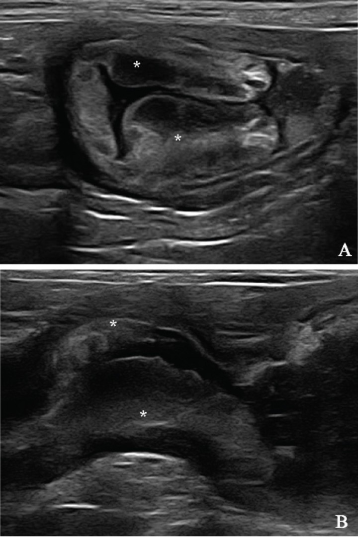 <div class=\"Basic-Text-Frame\">
<p>Imagen ecográfica de la zona del antro pilórico. (A) Corte transversal. (B) Corte longitudinal. Se visualiza un engrosamiento asimétrico de la pared (*) que protruye hacia la luz gástrica.</p>
</div>