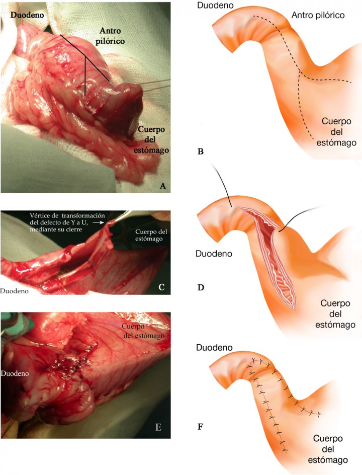 <p>Imágenes quirúrgicas de la realización de la piloroplastia de avance en Y-U (A-B) en la que se aprecian las líneas de incisión a espesor completo, comenzando con una línea sobre el antro pilórico que se extiende en forma de Y hacia el cuerpo del estómago (C-D) y la transformación del defecto en U, mediante su cierre (E-F).</p>