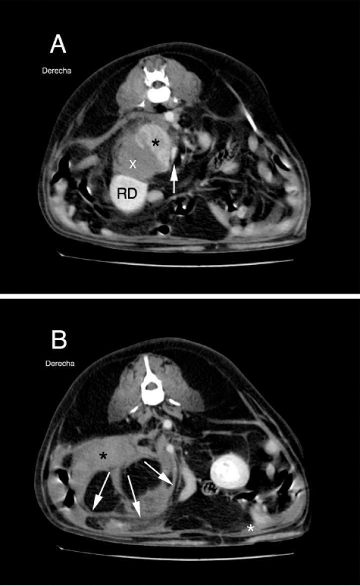<div>
<p>Imágenes de TC post-contraste en plano transversal de la región abdominal obtenidas 20 segundos después de la administración de contraste y ventana de tejido blando (WW400, WL60), ordenadas de craneal a caudal. (A) Se observa masa adrenal de aproximadamente 3,9 cm (DV) x 3,4 cm (LL) x 3,6 cm (Cr-Cd) con captación heterogénea de contraste (asterisco negro), que mantiene contacto con vena cava caudal sin mostrar invasión intraluminal, desplazándola ventro-medialmente (flecha blanca). Hematoma adyacente (x) que desplaza riñón derecho (RD) caudoventralmente. (B) Se observa la presencia de acúmulo de líquido en zona retroperitoneal (asterisco negro) y, en menor cantidad, en zona peritoneal (asterisco blanco), así como el efecto masa de la zona retroperitoneal (flechas blancas).</p>
</div>