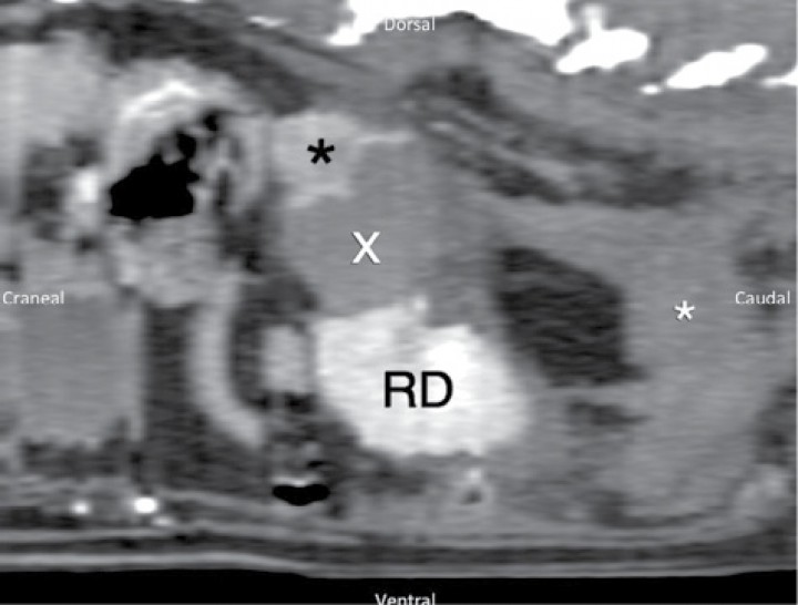 <div class=\"frame-2\">Imagen de TC post-contraste reformateada en plano sagital de la región abdominal en ventana de tejido blando (WW400, WL60), donde se muestra masa adrenal (asterisco negro) y hematoma adyacente (x) respecto a riñón derecho (RD) y hemorragia retroperitoneal (asterisco blanco).</div>