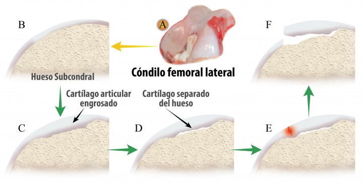<p>Esquema que muestra el proceso de desarrollo de la OCD. (A) Localización en el cóndilo femoral lateral. (B) Cartílago articular y hueso subcondral normal. (C) Engrosamiento del cartílago articular por la falta de vascularización del cartílago. (D) Separación de las capas de cartílago calcificado y no calcificado. (E) Formación de fisuras disecantes en los estratos del cartílago. (F) Formación del colgajo dejando expuesto el hueso subcondral.</p>