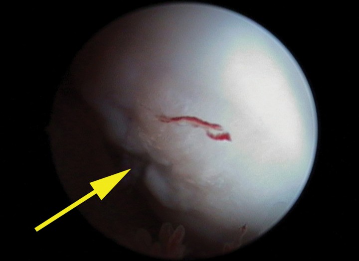 <p>Imagen artroscópica del cóndilo lateral del fémur derecho mostrando la lesión (flecha amarilla).</p>