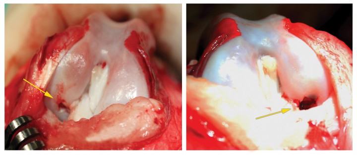 <p>Imagen macroscópica del cóndilo lateral después de la artrotomía. (A) Imagen del fémur derecho mostrando la lesión (flecha amarilla). (B) Imagen del fémur izquierdo mostrando la lesión (flecha amarilla).</p>