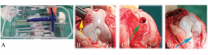 <p>(A) Material utilizado: set <em>Osteochondral Autograft Transfer Surgery</em> (OATS) de Arthrex<sup>TM</sup>, de 6 mm de diámetro. (B) Toma de injerto osteocondral de la zona donante del fémur izquierdo con el trocar (flecha amarilla). (C) Lesión de la zona donante una vez extraído el cilindro de injerto osteocondral (flecha verde). (D) Cilindro de injerto osteocondral reconstruyendo el defecto (flecha azul).</p>