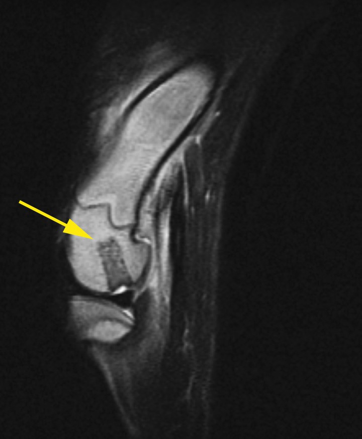 <p>Imagen de resonancia magnética en T2 y corte sagital del cóndilo femoral izquierdo a las 6 semanas de la realización del procedimiento quirúrgico. Se puede observar una cierta osteointegración, sobre todo en la zona de la base del cilindro a nivel del hueso subcondral (flecha amarilla).</p>