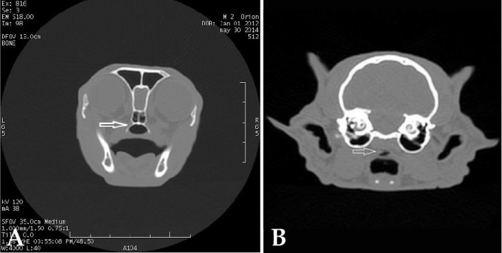 <p>Imagen de TC en ventana de huesos y plano transversal. (A) En nuestro caso, se observa un área de la nasofaringe de diámetro normal (flecha). (B) En una TC diagnóstica, se observa un estrechamiento caudal a nivel de nasofaringe (Cortesía de Diagnosfera).</p>