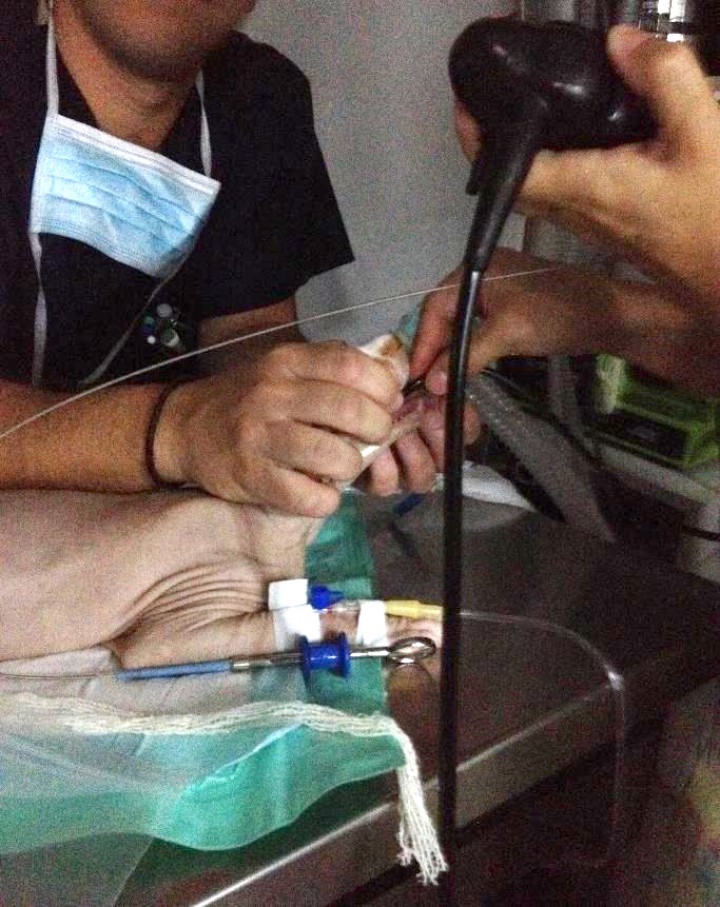 <p>Endoscopia de la región nasofaríngea con endoscopio flexible.</p>