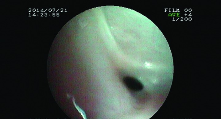 <p>Imagen endoscópica del estrechamiento por membrana a nivel de nasofaringe.</p>
