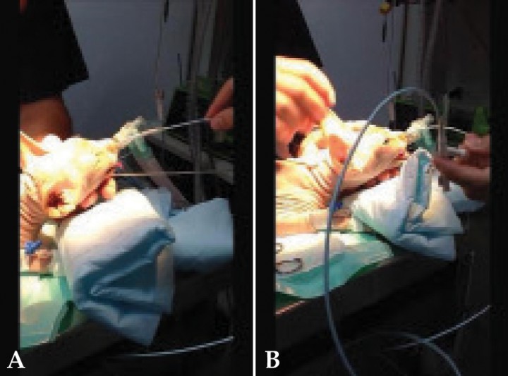 <p>(A) Introducción del catéter con balón por orificio nasal. (B) Una vez colocado el balón en nasofaringe, se procede a la dilatación.</p>