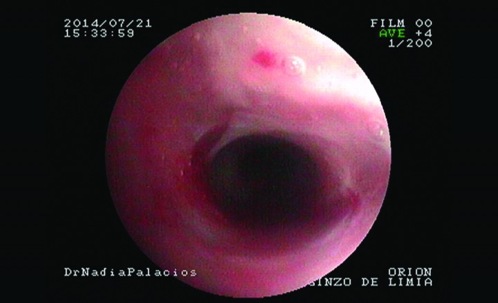 <p>Aspecto de la nasofaringe después de dos dilataciones con balón en la misma sesión.</p>