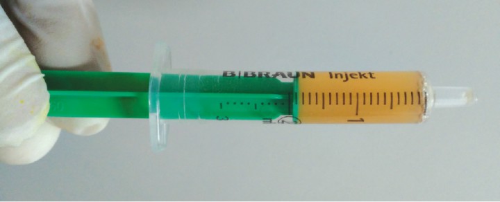 <p>Aspecto del líquido del abdomen obtenido por centesis. El resultado del análisis fue de trasudado modificado.</p>