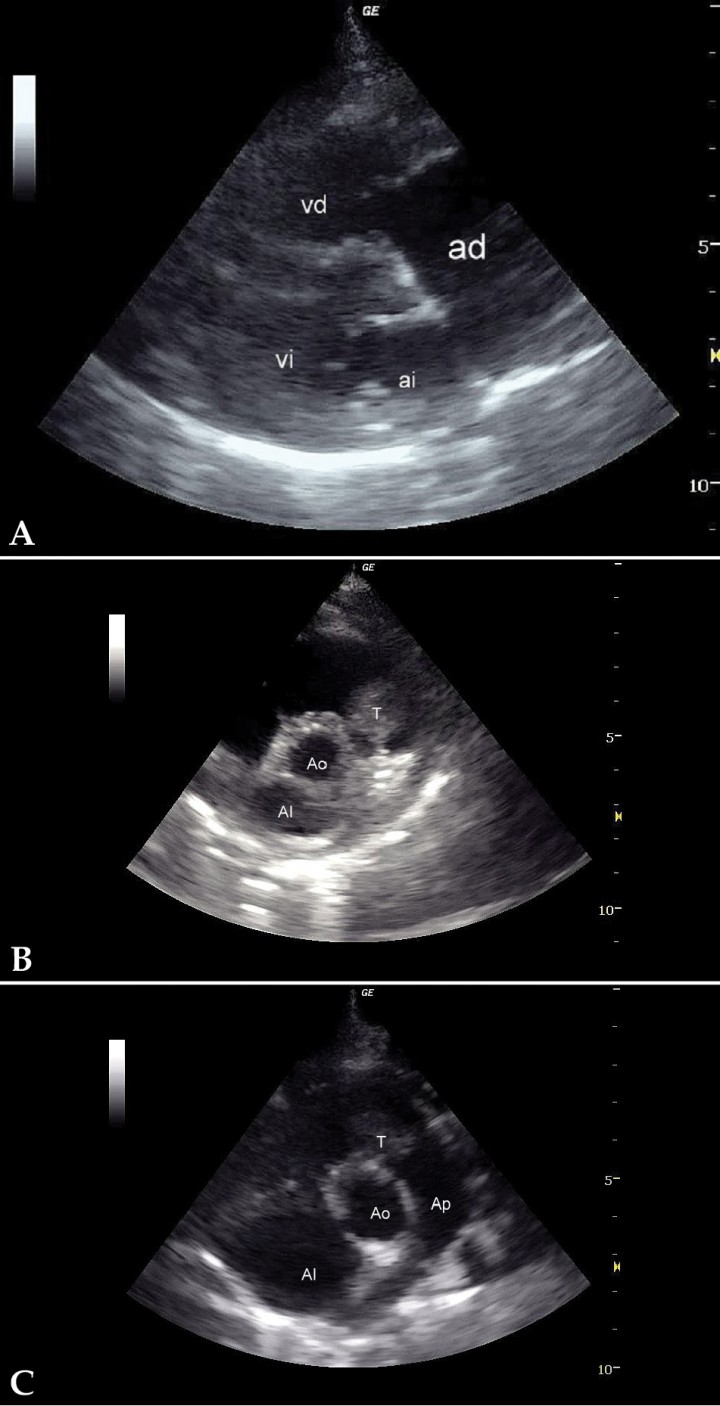 <p>(A) Corte paraesternal derecho, eje largo, 4 cámaras. Severa dilatación del atrio derecho. (B) Corte paraesternal derecho, eje corto. Presencia de una masa intraluminal en tracto de salida derecho. (C) Corte craneal izquierdo. Presencia de una masa intraluminal en tracto de salida derecho. AD: atrio derecho; AI: atrio izquierdo; VD: ventrículo derecho; VI: ventrículo izquierdo; T: tumor; Ao: aorta; AI: atrio izquierdo; Ap: arteria pulmonar.</p>