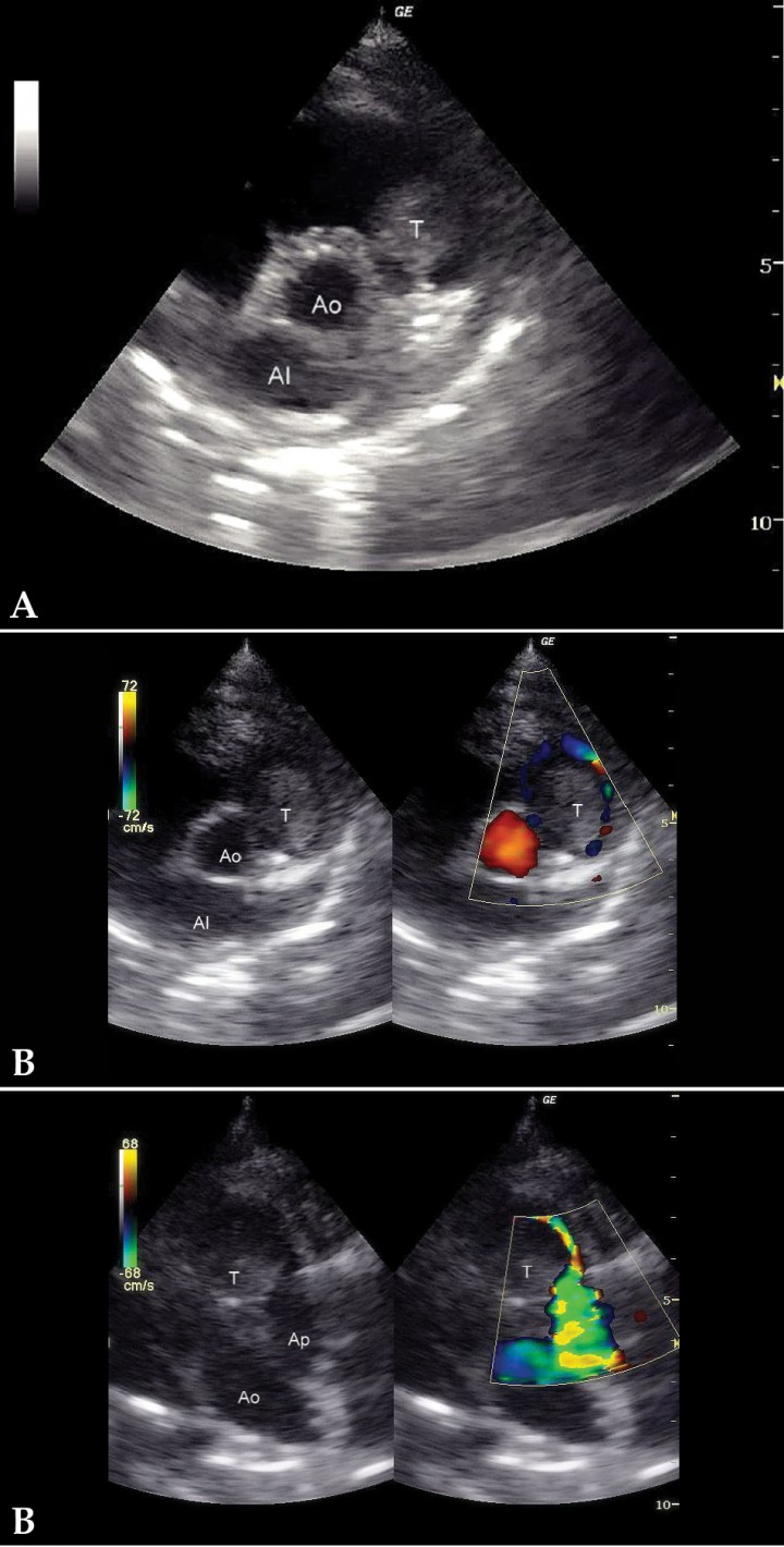 <p>(A) Corte paraesternal derecho, eje corto. (B) Corte craneal izquierdo. Doppler color con flujo sanguíneo rodeando la masa demostrando obstrucción mecánica del flujo. T: tumor; Ao: aorta; Ap: arteria pulmonar.</p>