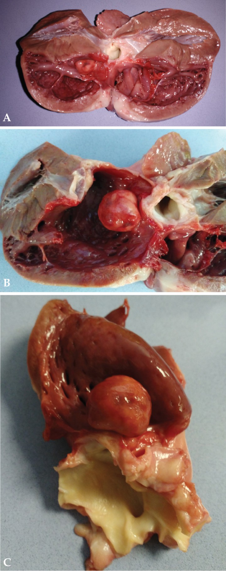 <p> (A) Aspecto macroscópico del corazón abierto en un plano longitudinal. Dilatación ventricular derecha. Presencia de tumor intraluminal en tracto de salida derecho. (B) Aspecto macroscópico del corazón abierto en un plano longitudinal tras resección de aparato valvular y músculos papilares. Dilatación ventricular derecha. Presencia de tumor intraluminal en tracto de salida derecho. (C) Aspecto macroscópico del corazón abierto en un plano longitudinal y disección de arteria pulmonar intacta. Presencia de tumor intraluminal en tracto de salida derecho.</p>