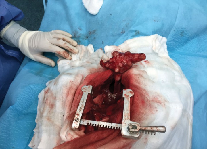 <p>Esternotomía media craneal y masa mediastínica.</p>