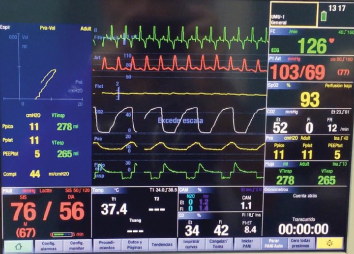 <p>Monitorización multiparamétrica intraoperatoria.</p>