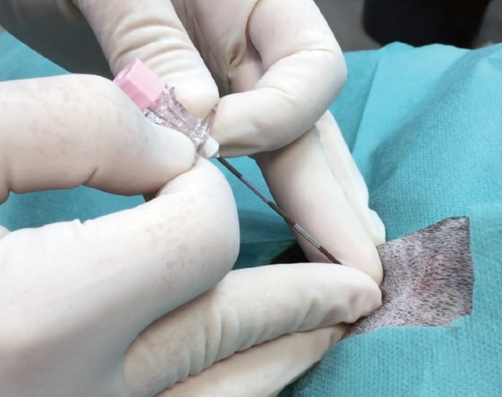 <p>Punción epidural con aguja Tuohy en el espacio lumbo-sacro.</p>