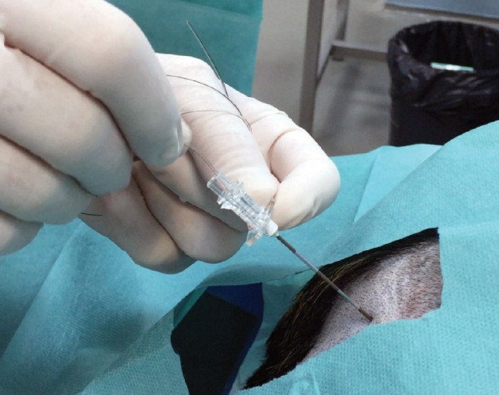 <p>Introducción del catéter epidural.</p>