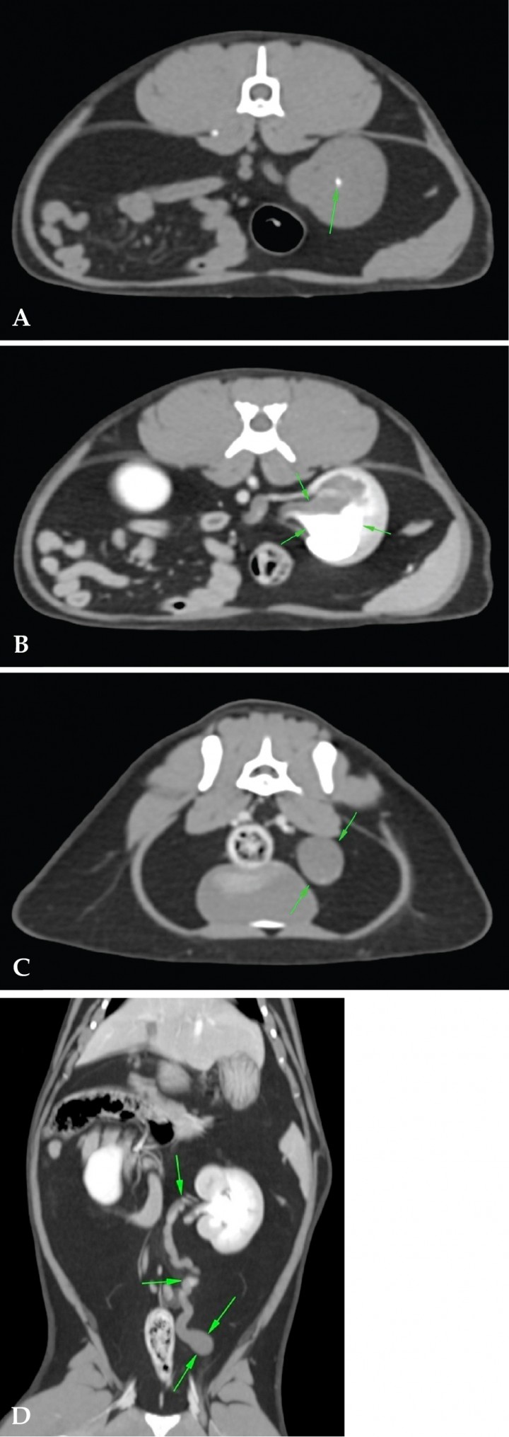 <p>(A) Imágenes de TC precontraste. Plano transversal. Se aprecia un nefrolito de pequeño tamaño (flecha verde). (B) Imágenes de TC postcontraste. Plano transversal. Se observa hidronefrosis e hidrouréter (flechas verdes) y dilatación bulbosa en la unión ureterovesical (flechas verdes). (C) Plano transversal. Ausencia de engrosamientos o masas (flechas verdes). (D) Plano dorsal. Drenaje deficiente del uréter izquierdo (flechas verdes).</p>