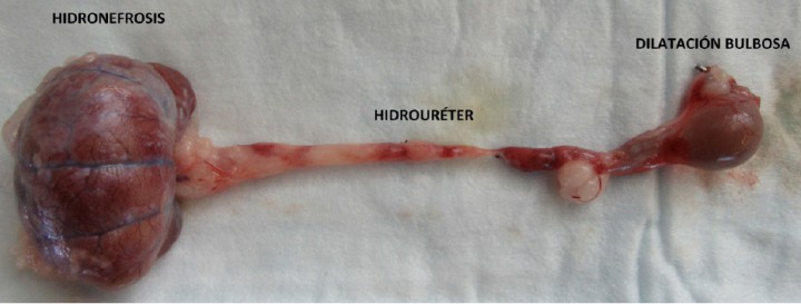<p>Imagen macroscópica del riñón, uréter, dilatación bulbosa y unión ureterovesical tras ureteronefrectomía por laparoscopia.</p>
