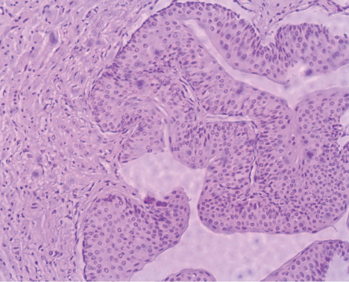 <p>Imagen histológica del uréter. Se observa una hiperplasia de la capa muscular y del epitelio transicional de revestimiento en la zona de resección. Tinción de Hematoxilina-Eosina (x100).</p>