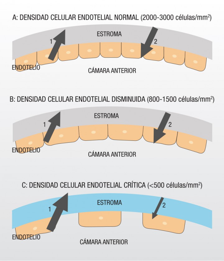 <p>(A) Si la densidad celular endotelial es adecuada (2000-3000 células/mm<sup>2</sup>), el humor acuoso (1) que penetra a través de las uniones celulares endoteliales es enviado hacia la cámara anterior (2) mediante la bomba endotelial, manteniéndose de esa forma el equilibrio endotelial. (B) Al empezar a disminuir la densidad endotelial, el endotelio corneal adopta dos mecanismos compensatorios: las células restantes aumentan su tamaño y modifican su forma, y aparecen más bombas endoteliales. Gracias a estas dos adaptaciones la fuga de humor acuoso sigue siendo igual a la devolución. (C) Por el contrario, si la densidad celular endotelial es inferior a 500 células/mm<sup>2</sup>, la función del endotelio se ve comprometida y el humor acuoso entra en mayor cantidad al estroma y no puede ser evacuado, produciéndose un edema estromal.</p>