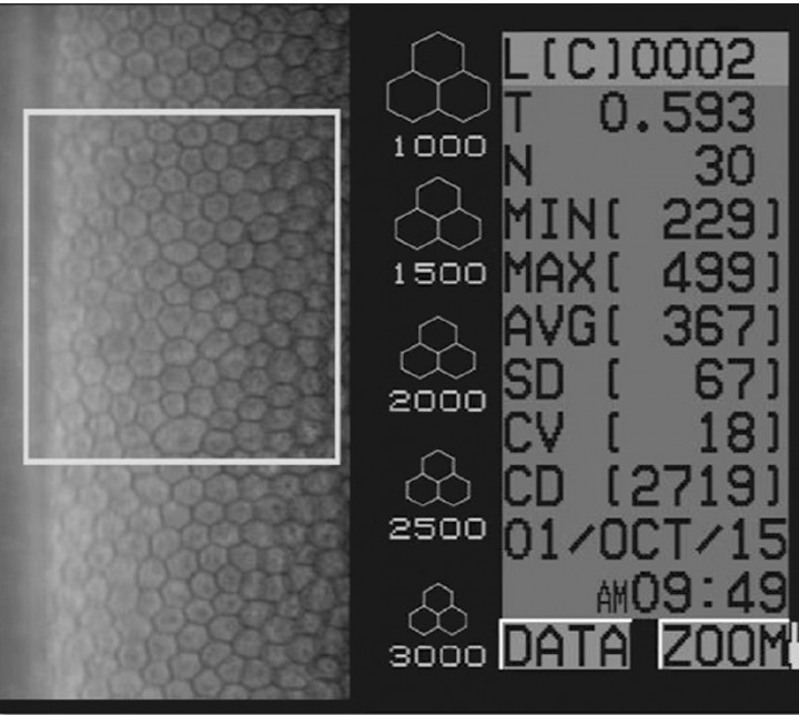 <p>Microfotografía del endotelio corneal normal de un perro cruzado de 2 años de edad, macho castrado, obtenida mediante microscopía especular de no contacto. N = número de células seleccionadas para el análisis, CD = densidad celular endotelial, T = grosor corneal, AVG = área media celular, CV = coeficiente de variación, que hace referencia al polimegatismo de la imagen.</p>