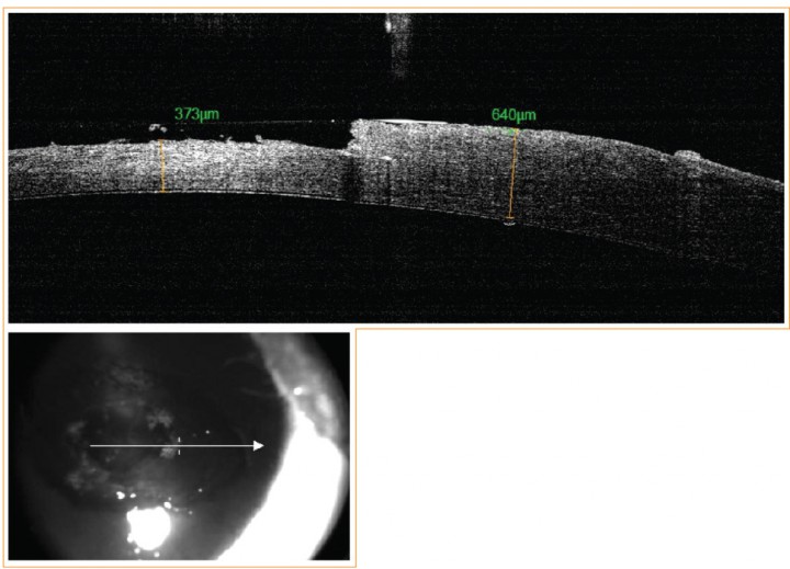 <p>OCT intraquirúrgica del ojo derecho.</p>