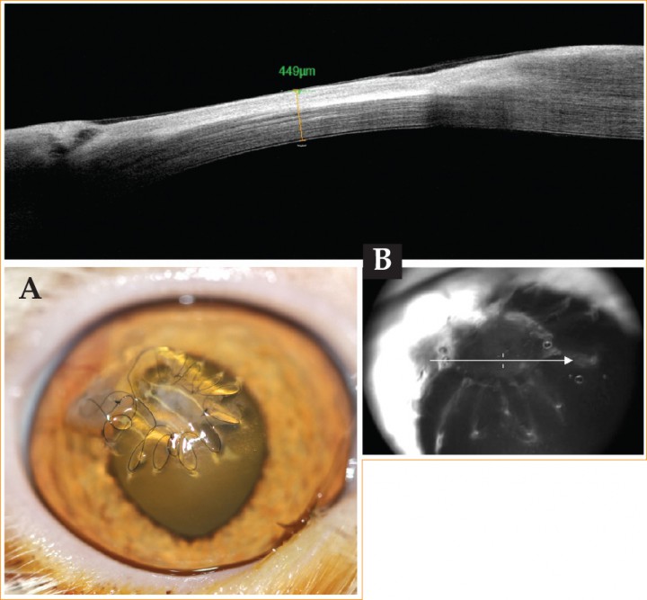 <p>(A) Imagen del ojo derecho tras retirar los puntos de la tarsorrafia. (B) OCT del ojo derecho tras retirar los puntos de la tarsorrafia.</p>