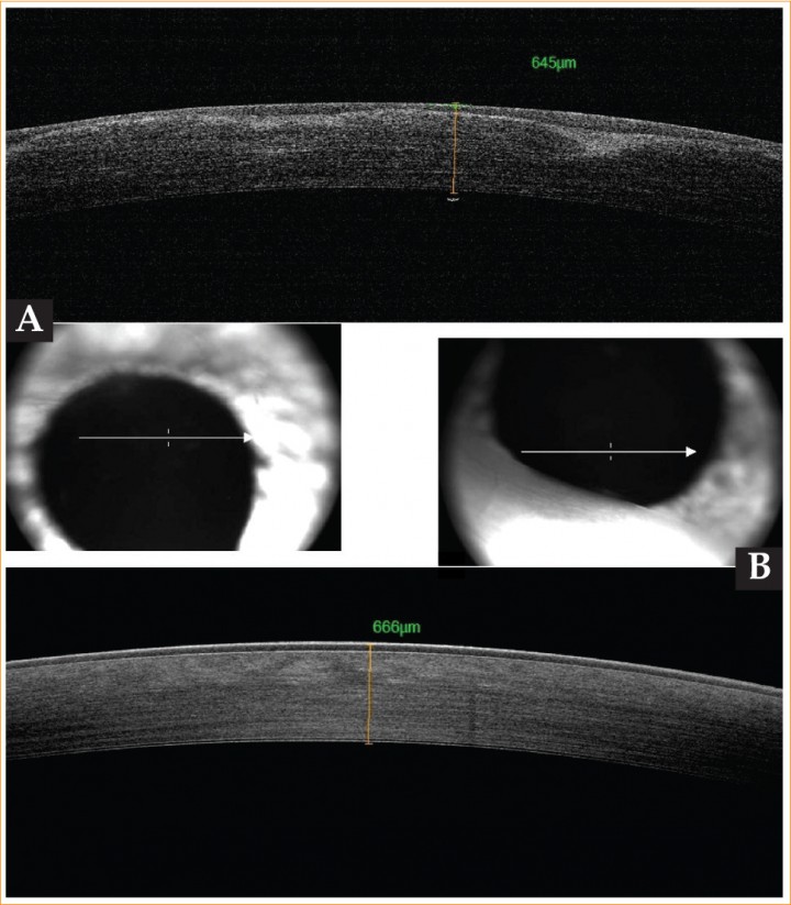 <p>(A) OCT del ojo derecho a los 4 meses de la cirugía. (B) OTC del ojo izquierdo a los 4 meses de la cirugía.</p>