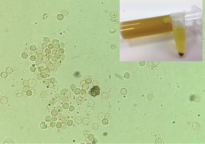 <p>Detalle de la orina y de sedimento urinario. Se aprecia en el centro de la imagen un cristal de urato de amonio. En pacientes con enfermedad hepatobiliar la deficiencia de urato oxidasa hepática puede conducir a concentraciones séricas aumentadas de ácido úrico, lo que, en conjunción con la hiperamonemia, genera la aparición de estos cristales, que se detectan en casi la mitad de los perros con shunts portosistémicos.</p>