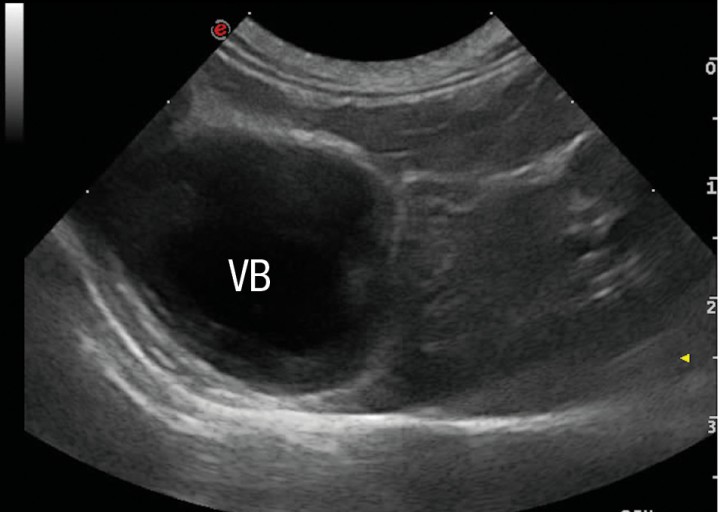 <p>Corte transversal del hígado. Se aprecia una disminución de tamaño del hígado. Vesícula biliar. (VB).</p>
