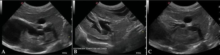 <p>(A) Cortes longitudinales de hígado parasagitales y oblicuos derechos. Se observa dilatación de los conductos biliares intrahepáticos y conducto cístico, así como la relación con la vesícula biliar (B y C) Conductos biliares dilatados.</p>